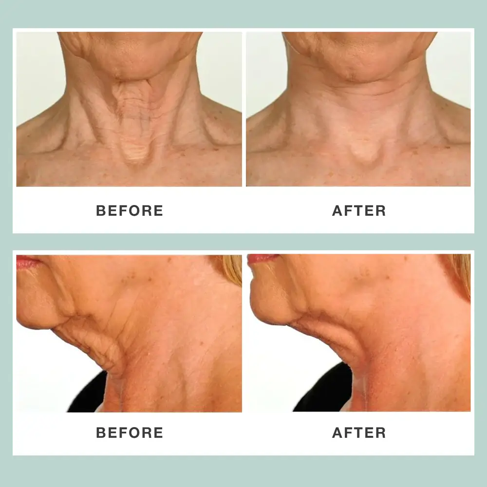 Contours Rx NECK RESCUE 30 Strips - Image 6