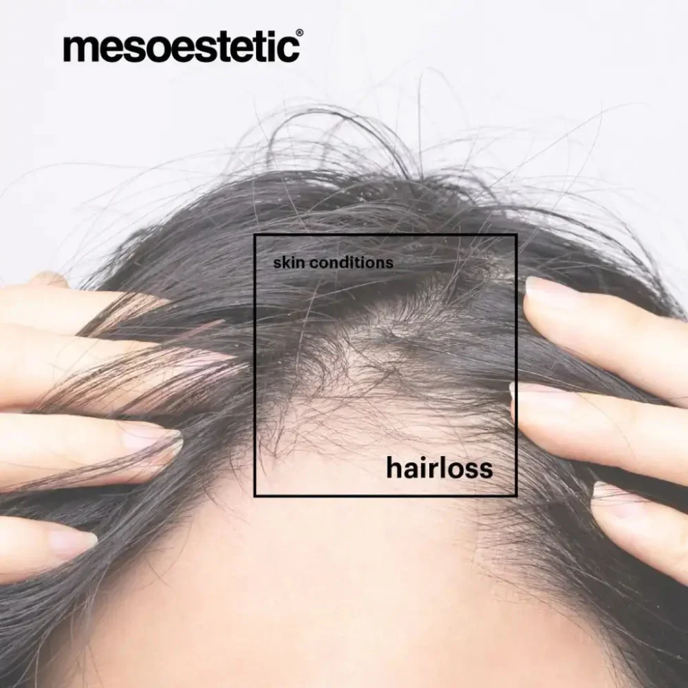 Mesoestetic Tricology Shampoo 225ml - Image 4