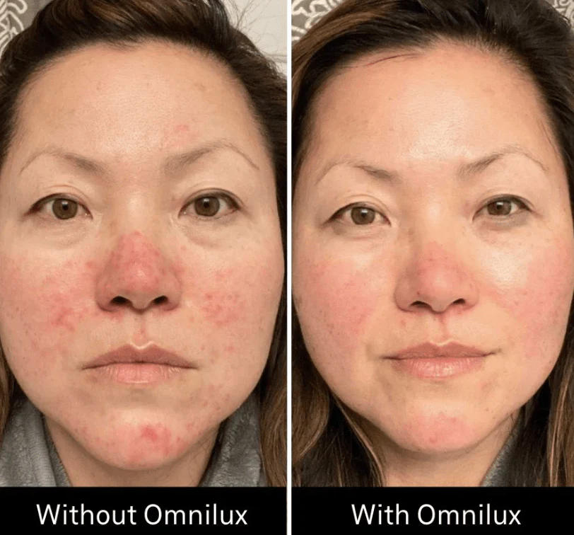 Omnilux Contour Face - Image 9