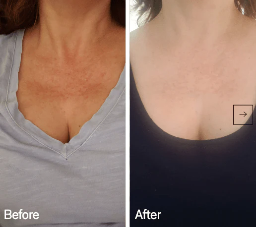 Omnilux Contour Neck & Décolleté - Image 4