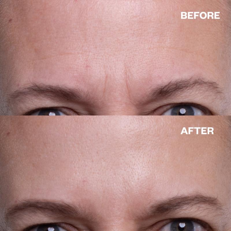 Wrinkles Schminkles Forehead Wrinkle Patch  - 1 Patch - Image 4